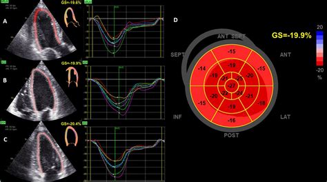 lv global longitudinal strain|Lv strain echo normal values.